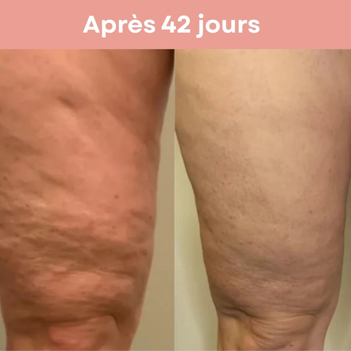 Appareil de Massage Anti-Cellulite 3 en 1 - Cap-Nature